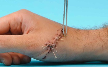 Timeline hồi phục sau cắt chỉ: Chăm sóc vết thương không để lại sẹo