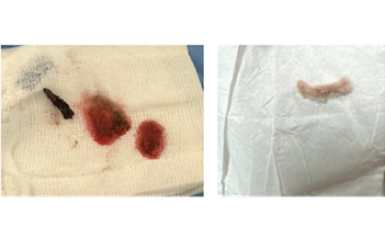 Ho ra máu, bé 3 tuổi nhập viện: Nguyên nhân từ dị vật dài 2 cm