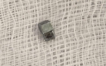 Bé trai 5 tuổi ho, đau họng, đi khám phát hiện nuốt 7 viên nam châm