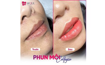 Thẩm mỹ viện Seoul Center - địa chỉ phun môi uy tín, đẹp, bền lâu