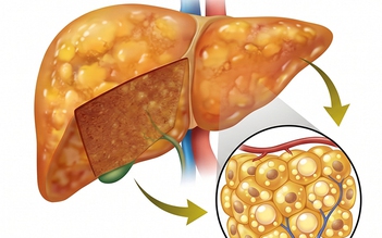 Gan nhiễm mỡ và máu nhiễm mỡ: Bệnh nào đáng lo hơn?
