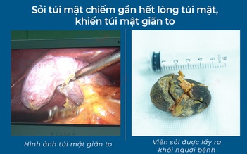 Phát hiện sỏi túi mật lớn gần bằng quả trứng gà khi khám sức khỏe định kỳ
