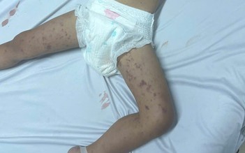 Xuất hiện viêm não mô cầu, Đắk Lắk khẩn trương truy vết người tiếp xúc