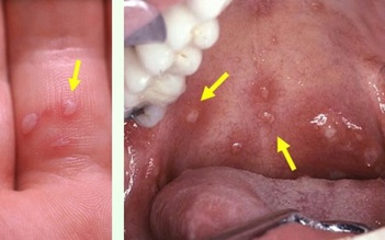 TP.HCM: Biến thể mới gây tay chân miệng nguy hiểm thế nào?