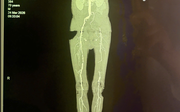 Loét gót chân kéo dài, bệnh nhân suýt phải cưa chân