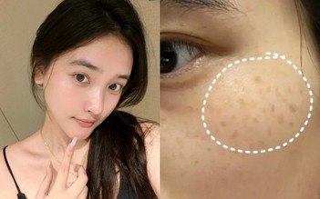 Top 7 kem giúp mờ nám da bật tone trắng hồng, hiệu quả cả nám hỗn hợp