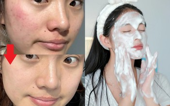 +7 sữa rửa mặt cho da dầu mụn sạch sâu mà ‘êm dịu’ ngừa mụn hiệu quả