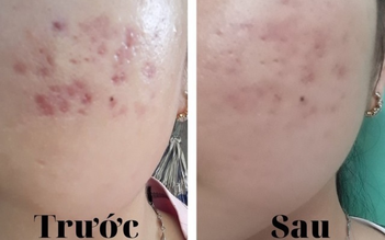 Sẹo thâm có tự hết được không? 99% đều tiếc vì biết điều này quá muộn!