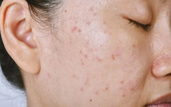Sữa rửa mặt nên có trong routine da dầu mụn của Trioderma?