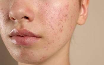 Kháng kháng sinh trong điều trị mụn và giải pháp thay thế từ tia Plasma lạnh