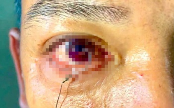 Cấp cứu bệnh nhân bị lưỡi câu ghim vào mắt