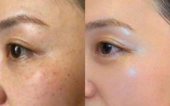 +5 serum mờ nám hỗn hợp, kể cả nám lâu năm cũng cải thiện nhanh chóng