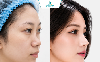 Xóa mũi tẹt cho thanh thiếu niên Việt - Trao cơ hội nâng mũi miễn phí