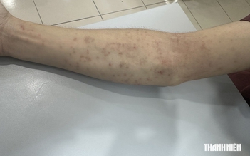 Trị tận gốc viêm da mùa nắng nóng
