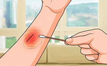 Xử lý vết thương hở đúng cách: Quy trình chăm sóc từ sơ cứu đến phục hồi