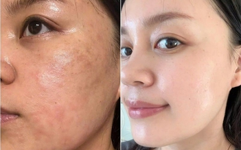 Da dầu mụn mùa nắng nóng ‘mê mẩn’ sản phẩm phục hồi này vì không bí da