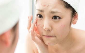 Cách trị thâm mụn tuổi dậy thì: Không biết sớm khiến nhiều bạn tự ti làn da