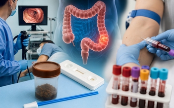 Từ 45 tuổi nên tầm soát ung thư đại trực tràng bằng cách nào?