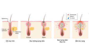 Gel chấm mụn nên dùng khi nào? Những lưu ý trước khi chấm mụn
