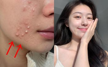 Top 4 kem chấm mụn ‘dập ổ mụn hiệu quả’ sáng dậy xẹp mụn không lo sẹo