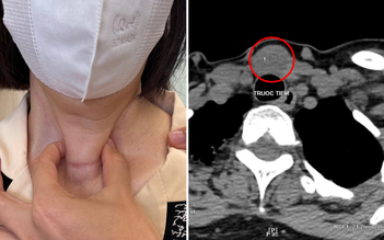 Ung thư giáp tái phát sau 2 lần mổ, hạch bám chặt dây thần kinh thanh quản