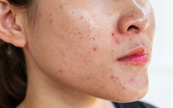 Da dầu mụn mãi không hết? Nhiều người mắc cùng một sai lầm khiến mụn tái phát