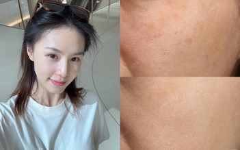 Top 6 serum mờ nám, tàn nhang sau khoảng 4 tuần khiến chị em đều không tin