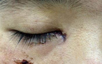 Va mặt vào cạnh bàn, cô gái phát hiện đứt lệ quản
