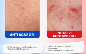 Gel chấm mụn Trioderma hiệu quả với loại mụn nào mà giới skincare đua nhau tìm mua?
