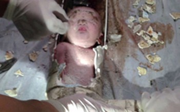 Em bé kẹt trong ống cống đã xuất viện