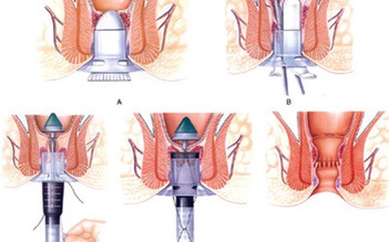 Phẫu thuật trĩ bằng phương pháp Longo