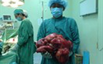 Lấy khối u nặng 11 kg ra khỏi ổ bụng bệnh nhân