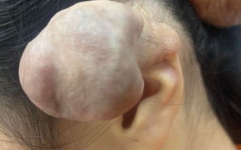 Bấm 6 lỗ tai, một phụ nữ bị biến dạng tai phải phẫu thuật nhiều lần