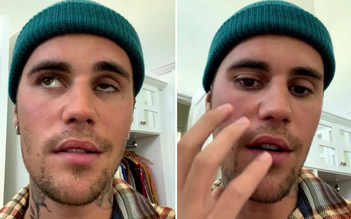 Loại virus nào khiến Justin Bieber bị liệt nửa mặt?