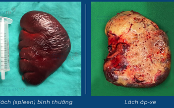 Cứu cụ ông bị áp xe lách kích thước lớn hiếm gặp