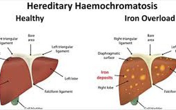 Thừa sắt do gien: Bệnh ít người biết nhưng vô cùng nguy hiểm
