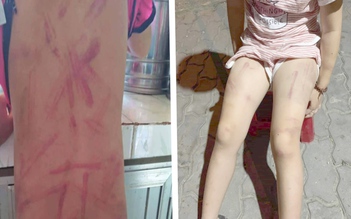 Phẫn nộ với hình ảnh bé gái 6 tuổi bị đánh đập bầm dập khắp người