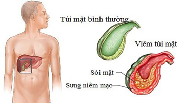 Người bị sỏi mật nên và không nên ăn gì?