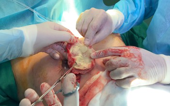 Bỏ quên gạc trong ngực bệnh nhân nâng ngực: Cơ sở phẫu thuật thẩm mỹ trá hình