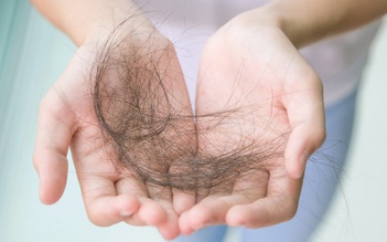 Mắc bệnh hiếm khiến người phụ nữ rụng tóc một nửa đầu