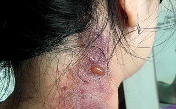 Nhiều người bị viêm da do kiến ba khoang nhưng nhầm là bệnh Zona