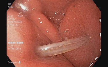 Bình Phước: Gắp ra xương cá dài 4 cm đâm sâu trong dạ dày bệnh nhân