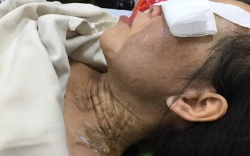 Đang chở con gái, mẹ bị tạt a xít vào mặt giữa Sài Gòn