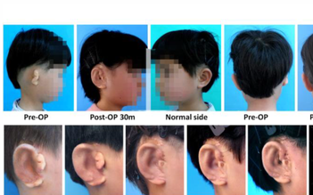 Phát triển thành công tai mới cho trẻ bị tật tai nhỏ
