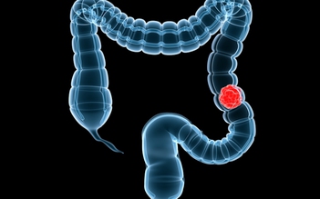 Tai sao mọi người nên xét nghiệm tầm soát ung thư đại trực tràng?