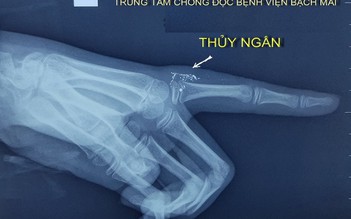 Nhiễm độc thủy ngân từ nhiệt kế