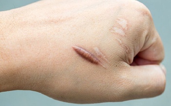 Bí quyết ngăn ngừa sẹo khi da tổn thương