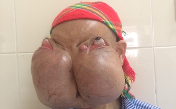 Bệnh nhân có khối u quái trên mặt