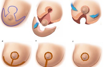 Phương pháp phẫu thuật mới điều trị ngực khủng, phì đại