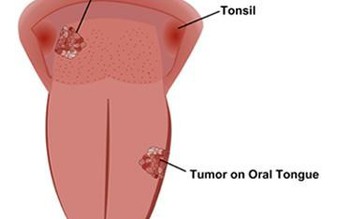 Cảnh báo vi sinh vật 'cư trú' trong khoang miệng gây ung thư